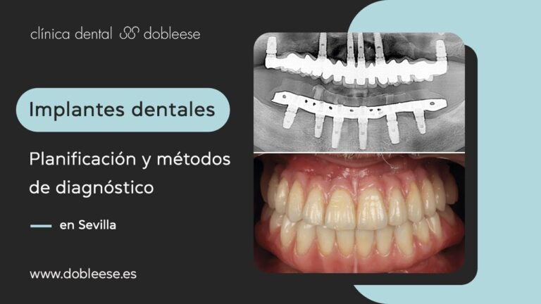 Implantes dentales en Sevilla: La solución perfecta para una sonrisa radiante